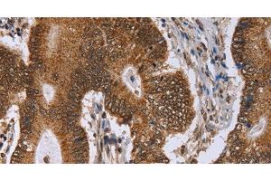 Immunohistochemistry of paraffin-embedded Human colon cancer tissue using ERCC6L Polyclonal Antibody at dilution 1:30 (ERCC6L Antikörper)