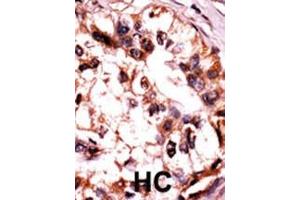 Formalin-fixed and paraffin-embedded human cancer tissue reacted with the primary antibody, which was peroxidase-conjugated to the secondary antibody, followed by AEC staining. (MAPK6 Antikörper  (pSer189))