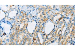 Immunohistochemistry of paraffin-embedded Human thyroid cancer tissue using ARSA Polyclonal Antibody at dilution 1:50 (Arylsulfatase A Antikörper)