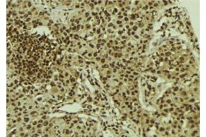 ABIN6278630 at 1/100 staining Human breast cancer tissue by IHC-P. (URI1 Antikörper  (Internal Region))