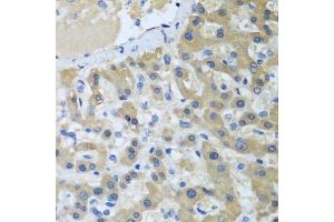 Immunohistochemistry of paraffin-embedded human liver cancer using XPC antibody. (XPC Antikörper  (AA 700-940))