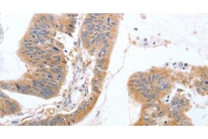 Immunohistochemistry of paraffin-embedded Human colon cancer tissue using TGFA Polyclonal Antibody at dilution 1:60 (TGFA Antikörper)