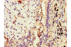 Immunohistochemistry of paraffin-embedded human lung cancer using ABIN7169671 at dilution of 1:100 (STAT2 Antikörper  (AA 571-851))