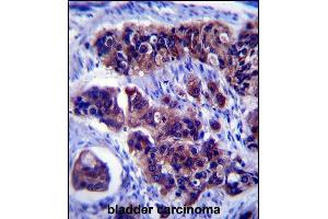 ZDHHC24 Antibody (C-term) (ABIN657453 and ABIN2846480) immunohistochemistry analysis in formalin fixed and paraffin embedded human bladder carcinoma followed by peroxidase conjugation of the secondary antibody and DAB staining. (ZDHHC24 Antikörper  (C-Term))