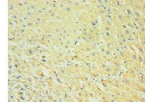 Immunohistochemistry of paraffin-embedded human liver cancer using ABIN7146296 at dilution of 1:100 (CALHM1 Antikörper  (AA 202-346))