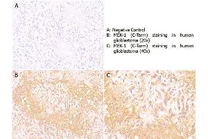 Immunohistochemistry with anti-MEK1 (C-Term) antibody showing positive staining in human glioblastoma tissue at 20x and 40x (B & C). (MEK1 Antikörper  (C-Term))