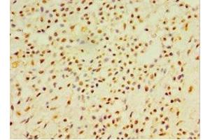 Immunohistochemistry of paraffin-embedded human breast cancer using ABIN7145488 at dilution of 1:100 (DEFB4A Antikörper  (AA 1-64))
