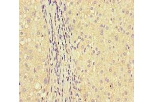 Immunohistochemistry of paraffin-embedded human liver cancer using ABIN7154022 at dilution of 1:100 (GLUL Antikörper  (AA 86-373))