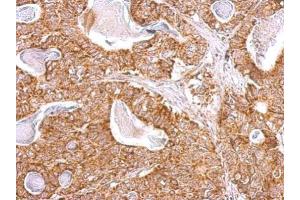 IHC-P Image NDUFB9 antibody detects NDUFB9 protein at cytosol on human gastric cancer by immunohistochemical analysis.