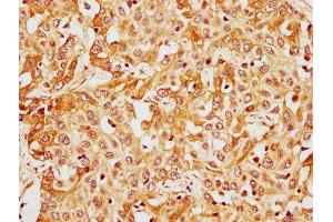 IHC image of ABIN7148386 diluted at 1:400 and staining in paraffin-embedded human liver cancer performed on a Leica BondTM system. (CFHR1 Antikörper  (AA 132-221))