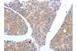 The image on the left is immunohistochemistry of paraffin-embedded Human breast cancer tissue using ABIN7190790(GFRA4 Antibody) at dilution 1/40, on the right is treated with synthetic peptide. (GFRA4 Antikörper)