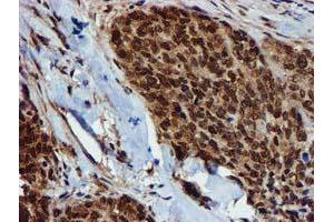 Immunohistochemical staining of paraffin-embedded Adenocarcinoma of Human breast tissue using anti-GSTT2 mouse monoclonal antibody. (GSTT2 Antikörper)
