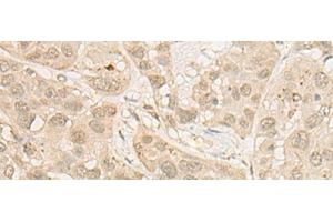 Immunohistochemistry of paraffin-embedded Human esophagus cancer tissue using RSU1 Polyclonal Antibody at dilution of 1:30(x200) (RSU1 Antikörper)