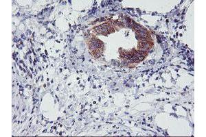 Immunohistochemical staining of paraffin-embedded Carcinoma of Human pancreas tissue using anti-NMT2 mouse monoclonal antibody. (NMT2 Antikörper)