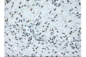 Immunohistochemical staining of paraffin-embedded Adenocarcinoma of colon tissue using anti-BRAFmouse monoclonal antibody. (BRAF Antikörper)