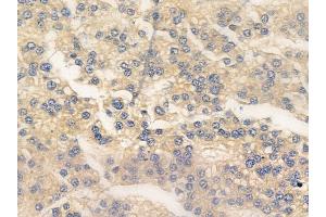 ABIN6255950 and ABIN6267275 at 1/100 staining human hepatocellular carcinoma by IHC-P. (Estrogen Receptor alpha Antikörper  (pTyr537))