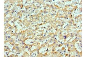Immunohistochemistry of paraffin-embedded human liver cancer using ABIN7154901 at dilution of 1:100 (HSPH1 Antikörper  (AA 659-858))