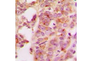 Immunohistochemical analysis of HSP70 staining in human breast cancer formalin fixed paraffin embedded tissue section.