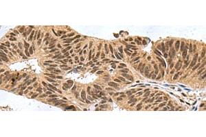 Immunohistochemistry of paraffin-embedded Human colorectal cancer tissue using FBXO32 Polyclonal Antibody at dilution of 1:60(x200) (FBXO32 Antikörper)
