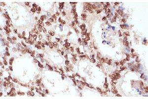 Immunohistochemistry of paraffin-embedded Human colon carcinoma using Phospho-β-catenin(S33/S37/T41) Polyclonal Antibody at dilution of 1:100 (40x lens). (beta Catenin Antikörper  (pSer33, pSer37, pThr41))