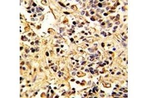 IHC analysis of FFPE human kidney carcinoma with Neprilysin antibody (MME Antikörper  (AA 506-534))