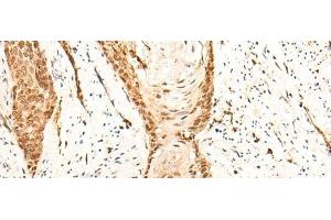 Immunohistochemistry of paraffin-embedded Human esophagus cancer tissue using EMSY Polyclonal Antibody at dilution of 1:25(x200)