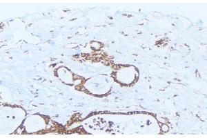 ABIN6275413 at 1/100 staining Human lung cancer tissue by IHC-P.