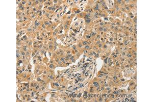 Immunohistochemistry of Human esophagus cancer using SLC11A2 Polyclonal Antibody at dilution of 1:50 (SLC11A2 Antikörper)