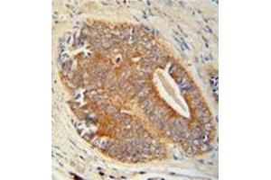 Immunohistochemistry analysis in formalin fixed and paraffin embedded human prostate carcinoma reacted with GAGE7 Antibody (C-term) followed by peroxidase conjugation of the secondary antibody and DAB staining. (G Antigen 7 Antikörper  (C-Term))