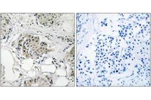 Immunohistochemistry analysis of paraffin-embedded human breast carcinoma tissue, using USP13 Antibody.