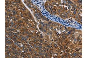 The image on the left is immunohistochemistry of paraffin-embedded Human ovarian cancer tissue using ABIN7129016(COX6B2 Antibody) at dilution 1/50, on the right is treated with fusion protein. (COX6B2 Antikörper)