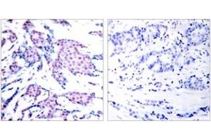 Immunohistochemistry analysis of paraffin-embedded human breast carcinoma, using c-Jun (Phospho-Thr93) Antibody. (C-JUN Antikörper  (pThr93))