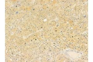 ABIN6260416 and ABIN6279231 at 1/100 staining human hepatocellular carcinoma by IHC-P. (CALML6 Antikörper  (Internal Region))