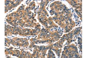 The image on the left is immunohistochemistry of paraffin-embedded Human breast cancer tissue using ABIN7189781(ALOX15 Antibody) at dilution 1/60, on the right is treated with synthetic peptide. (ALOX15 Antikörper)