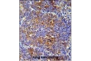 MCAF2 Antibody (Center) (ABIN654466 and ABIN2844199) immunohistochemistry analysis in formalin fixed and paraffin embedded human lung carcinoma followed by peroxidase conjugation of the secondary antibody and DAB staining. (ATF7IP2 Antikörper  (AA 318-347))