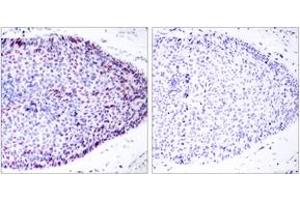 Immunohistochemistry analysis of paraffin-embedded human breast carcinoma tissue, using ATF2 (Ab-62 or 44) Antibody. (ATF2 Antikörper  (AA 29-78))