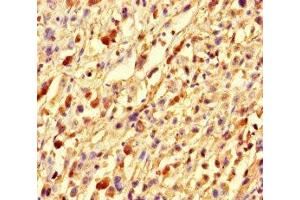 Immunohistochemistry of paraffin-embedded human melanoma using ABIN7153773 at dilution of 1:100 (GMIP Antikörper  (AA 719-858))