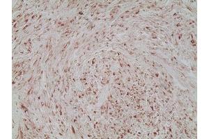 Immunohistochemistry analysis of human melanoma skin tissue using Melanoma marker (human) mAb (HMB45), (ABIN7211713) at a dilution of 1:20. (Melanoma Marker Antikörper)