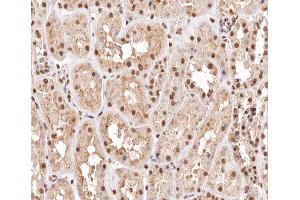 ABIN6267454 at 1/200 staining human kidney carcinoma tissue sections by IHC-P.