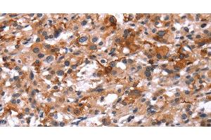Immunohistochemistry of paraffin-embedded Human thyroid cancer using Glucagon Receptor Polyclonal Antibody at dilution of 1:40 (Glucagon Receptor Antikörper)