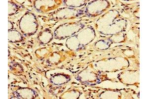 Immunohistochemistry of paraffin-embedded human gastric cancer using ABIN7156344 at dilution of 1:100 (IDE Antikörper  (AA 501-800))
