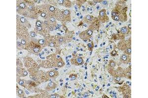 Immunohistochemistry of paraffin-embedded Human liver damage using TGFA Polyclonal Antibody (TGFA Antikörper)