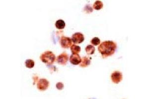 Imunohistochemical analysis of human alveolar macrophages, using MSR1 monoclonal antibody, clone SRA-C6  . (Macrophage Scavenger Receptor 1 Antikörper)