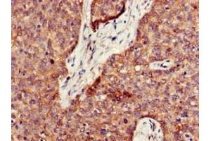Immunohistochemistry of paraffin-embedded human ovarian cancer using ABIN7162531 at dilution of 1:100 (PPT1 Antikörper  (AA 100-258))