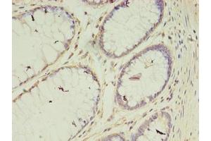 Immunohistochemistry of paraffin-embedded human colon cancer using ABIN7175400 at dilution of 1:100