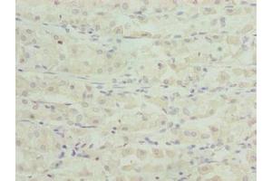 Immunohistochemistry of paraffin-embedded human gastric cancer using ABIN7171874 at dilution of 1:100 (TSPAN33 Antikörper  (AA 118-235))