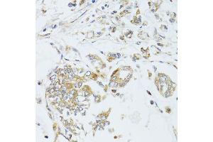 Immunohistochemistry of paraffin-embedded human gastric cancer using MAD2L2 antibody (ABIN6003593) at dilution of 1/100 (40x lens). (MAD2L2 Antikörper)