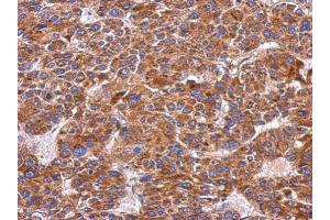 IHC-P Image Immunohistochemical analysis of paraffin-embedded human hepatoma, using Integrin alpha 9, antibody at 1:500 dilution.