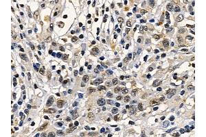 Retinoblastoma Mouse Monoclonal Antibody at 1/100 staining human gastric cancer by IHC-P.