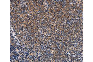Immunohistochemistry of Human lung cancer using CCL23 Polyclonal Antibody at dilution of 1:50